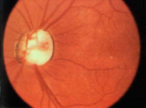 glaucoma.jpg (45678 byte)
