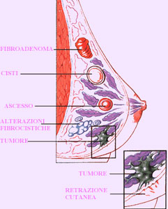 Papilloma intraduttale tumore - Papilloma intraduttale mammario Papilloma duttale mammario