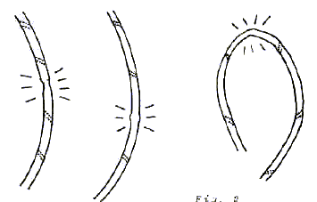 Figura 2. Lesioni della corda.